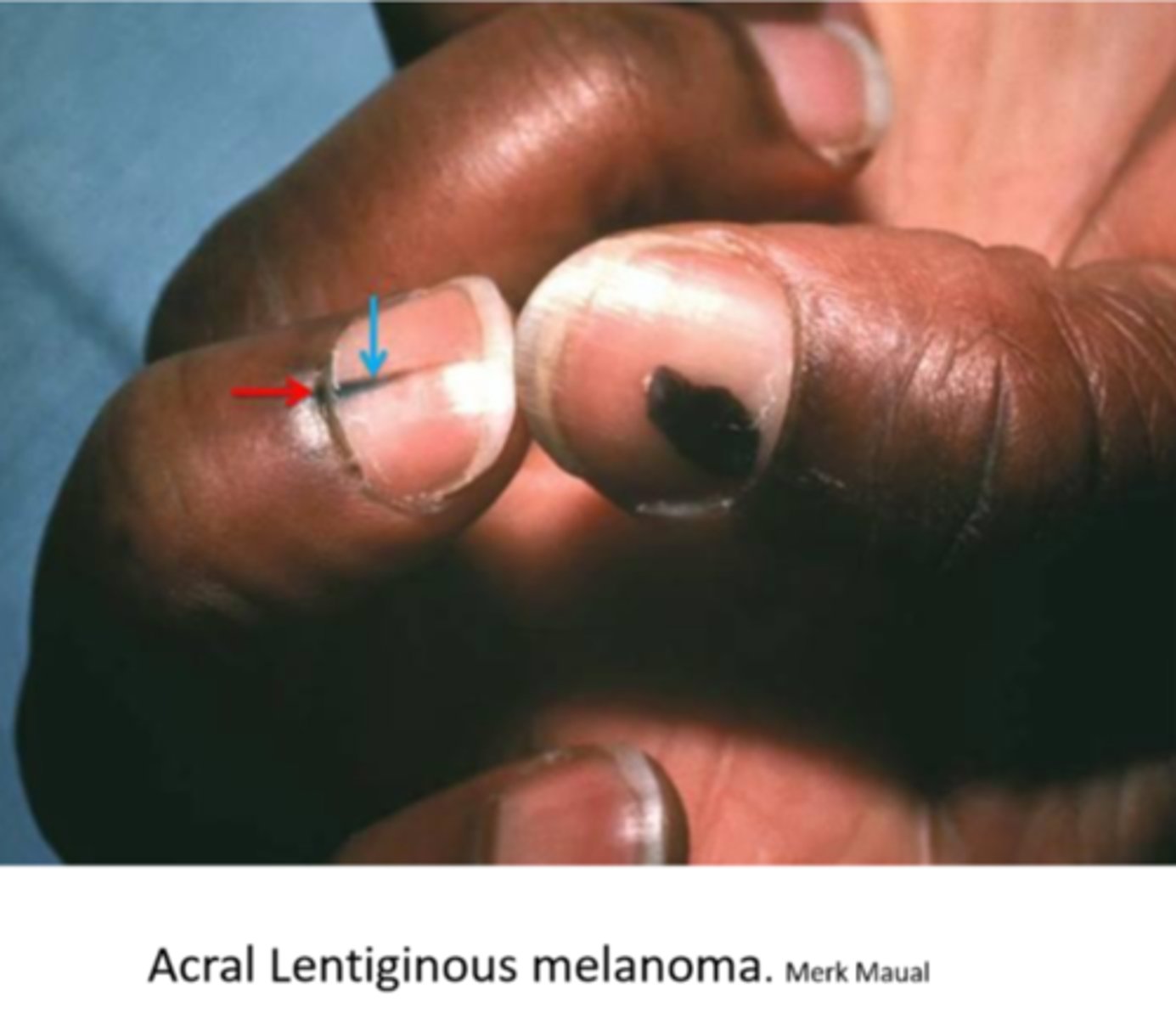 <p>seen on soles, palms, fingernails (moreso seen in AA and Asian)</p>