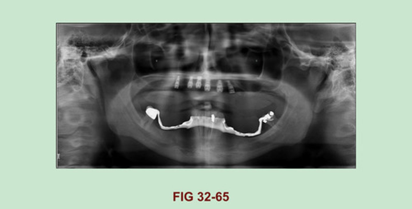 <p>Maxilla: Dental implants</p><p>Mandible: Partial denture or special appliance space holder (correct me if I am wrong, this one I did not see in the textbook).</p>