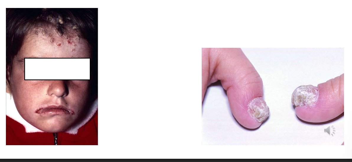<ul><li><p>Presents in<strong> childhood or infancy</strong>, recurrent <strong>oral, skin, nail infection</strong>.</p></li><li><p>Skin <strong>lesions </strong>crusted on face and scalp - <strong>“candida granuloma”</strong></p></li><li><p>Immunological abnormalities involved, not characterised CMC <strong>may be inherited,</strong> associated with hypoparathyroidism or hypoadrenalism, hypothyroidism, or idiopathic</p></li></ul><p></p>