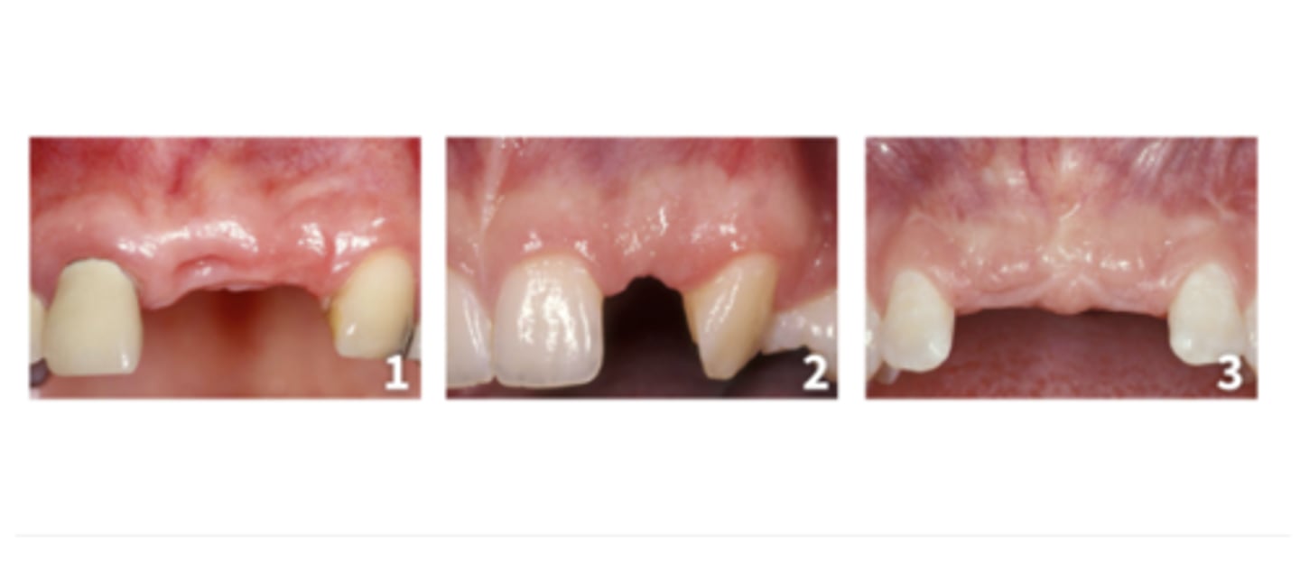 <p>Based on the ITI Esthetic risk assessment for partial edentulous situation, which clinical scenario has highest esthetic risk with regard to the width of the edentulous span. (Select one answer)</p><p>a. Scenario 1 (Medical distal distance 13mm) with restored adjacent teeth</p><p>c. Scenario 3 (Medical distal distance 16mm) with native adjacent teeth</p><p>b. Scenario 2 (Medical distal distance 7mm) with native adjacent teeth</p>