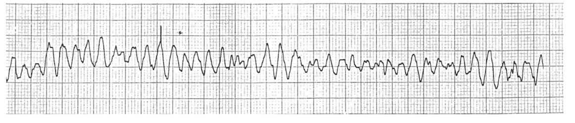 <p>Practice Q 8: </p><p>While exercising a patient on the treadmill, the physical therapist notices the electrocardiogram as shown in the image. What should their INITIAL response be?</p><p>A. Continue walking at same intensity</p><p>B. Continue walking at lower intensity</p><p>C. Stop the treatment and monitor ECG for 10 minutes</p><p>D. Activate the emergency system or call 911</p><p></p><p>What is dx?</p>