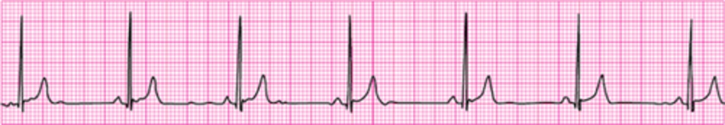 <p>Atropine 1 mg IV</p>