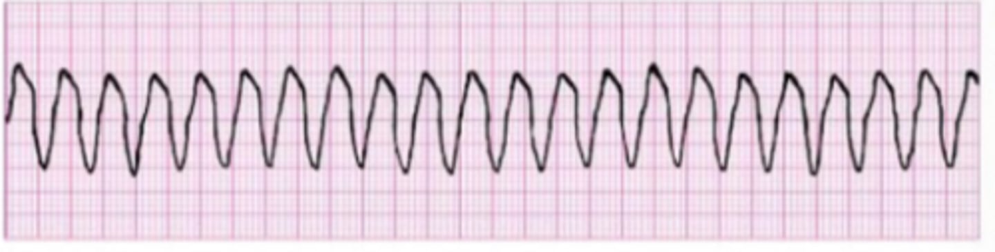 <p>Originate: ventricular automaticity focus</p><p>QRS complex: wide</p><p>P wave: none</p><p>Heart rate: very rapid</p><p>R-R intervals: regular</p>