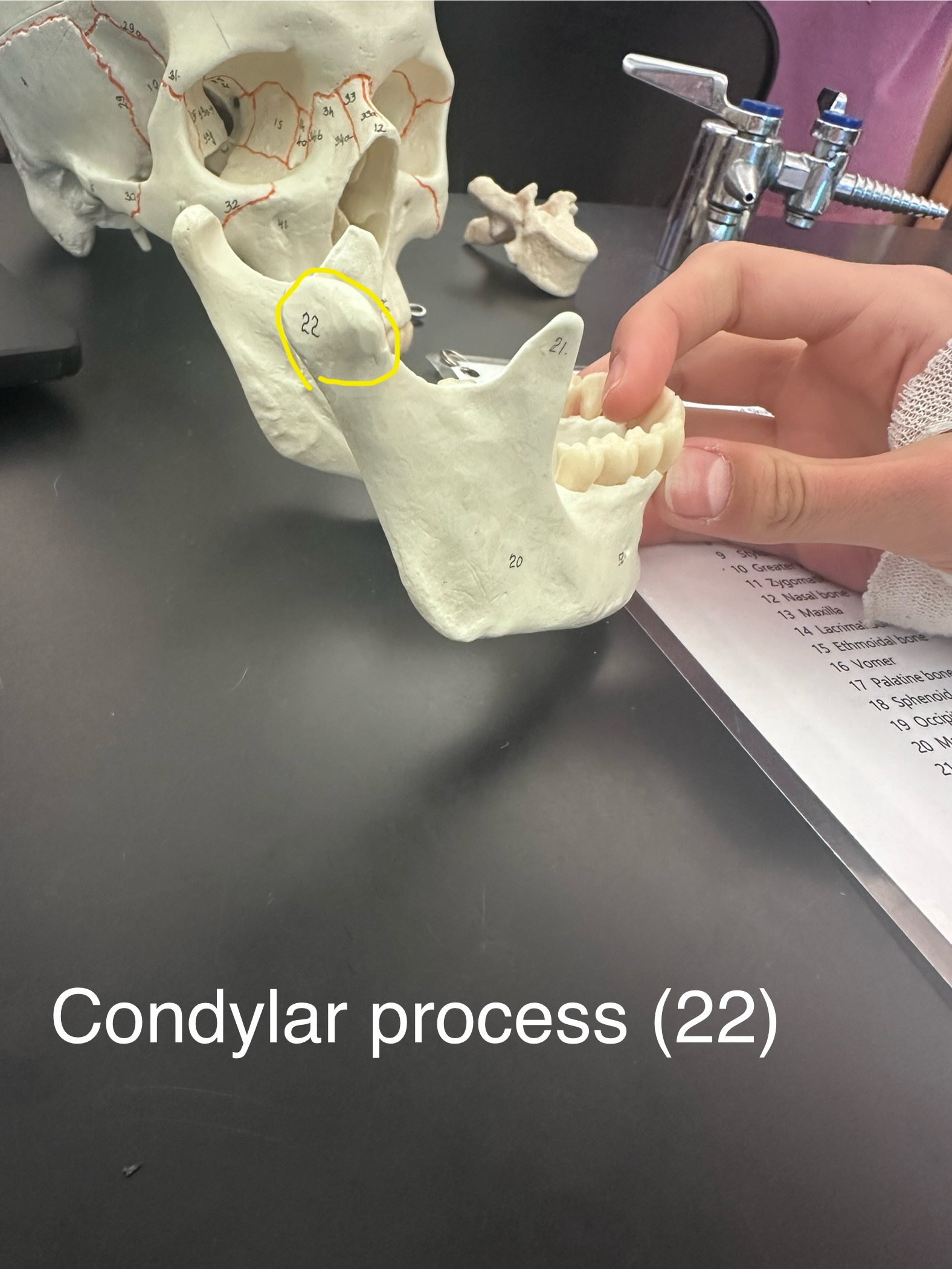 <p>Condylar processes (Mandibular Condyles)</p>
