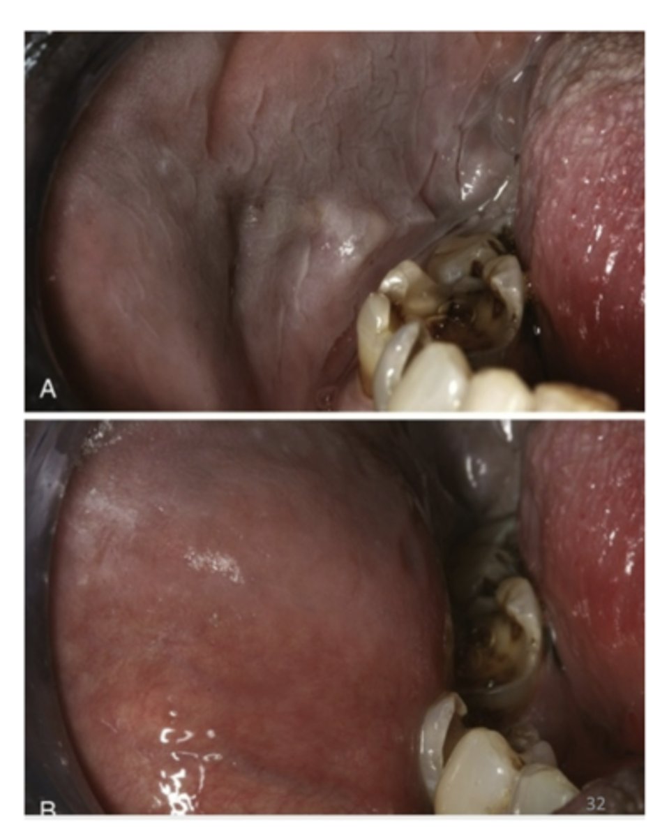 <p>What is the Diagnosis of Leukodema? </p>