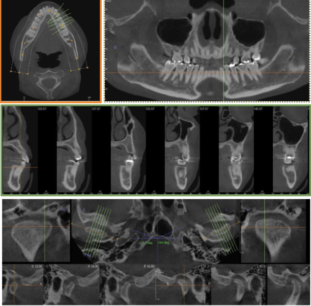 <p>What are the types of multiplanar reformations?</p>
