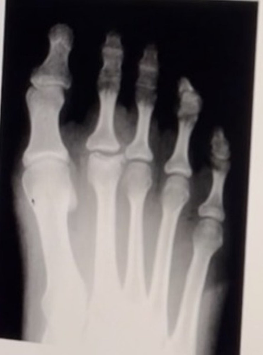 <p>Please choose two possible causes for the condition seen above.</p><p>Select 2 correct answers:</p><p>High heeled shoes</p><p>Septic arthritis</p><p>Metatarsal crush injury</p><p>Elongated second digit</p>