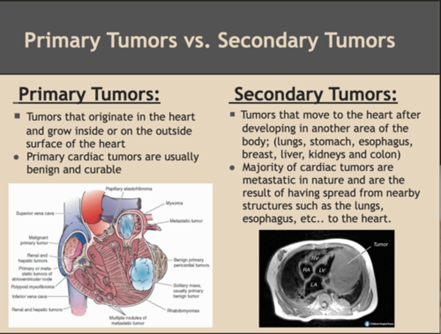 <p>•When a malignant tumour metastasises, the original tumour is called the primary tumour, and the tumour that has spread from the primary tumour is called the secondary tumour.</p><p>•Secondary tumours are often more difficult to treat than primary tumours because they have the ability to spread to other parts of the body and may therefore be more widespread and harder to locate and completely eliminate.</p><p>•secondary tumours indicate a more advanced stage of cancer, more likely to affect vital organs or functions.</p>