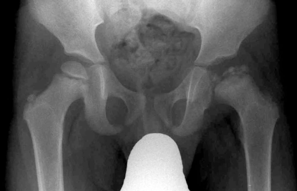 <p>Associated with ischemic necrosis of bone. Ischemia results from poor blood supply to the bone. Affects the epiphyses and may be mistaken for tuberculosis of the skeletal system. Tends to occur in males between the ages of 5 to 10 years and often follows injury to the affected hip. Radiographically the bone in the center of the epiphysis is fragmented and the head of the femur is flattened.</p>