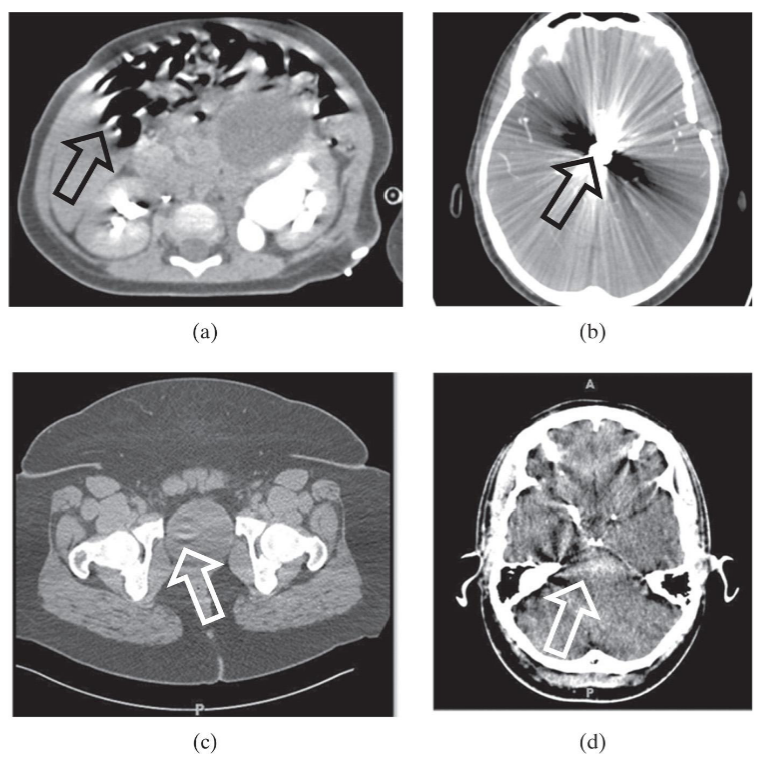 <p>features of an image that do not represent valid anatomical or functional information. obscure</p><p>a = motion, b = star from metal, c = detectors out of calibration, d = xray beam hardening</p>