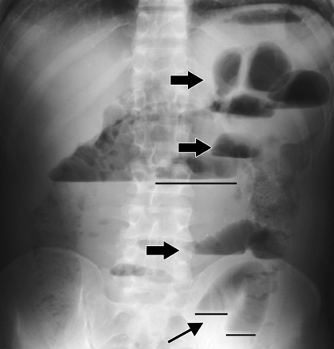 <p>can be either mechanical or function</p><p>• mechanical obstruction - caused by an intraluminal, mural, or extrinsic mass, which can be secondary to a foreign body, obstructing tumor in the wall, or an extrinsic compression from an adhesion, or an embryological band</p><p>• function obstruction - due to an inability of the bowel to peristalse</p>