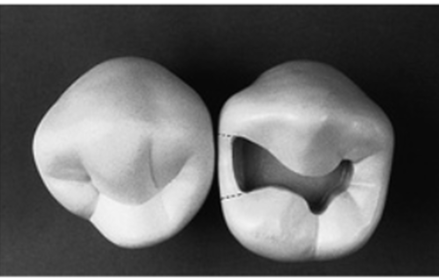 <p>location of proximo-occlusal margins</p>