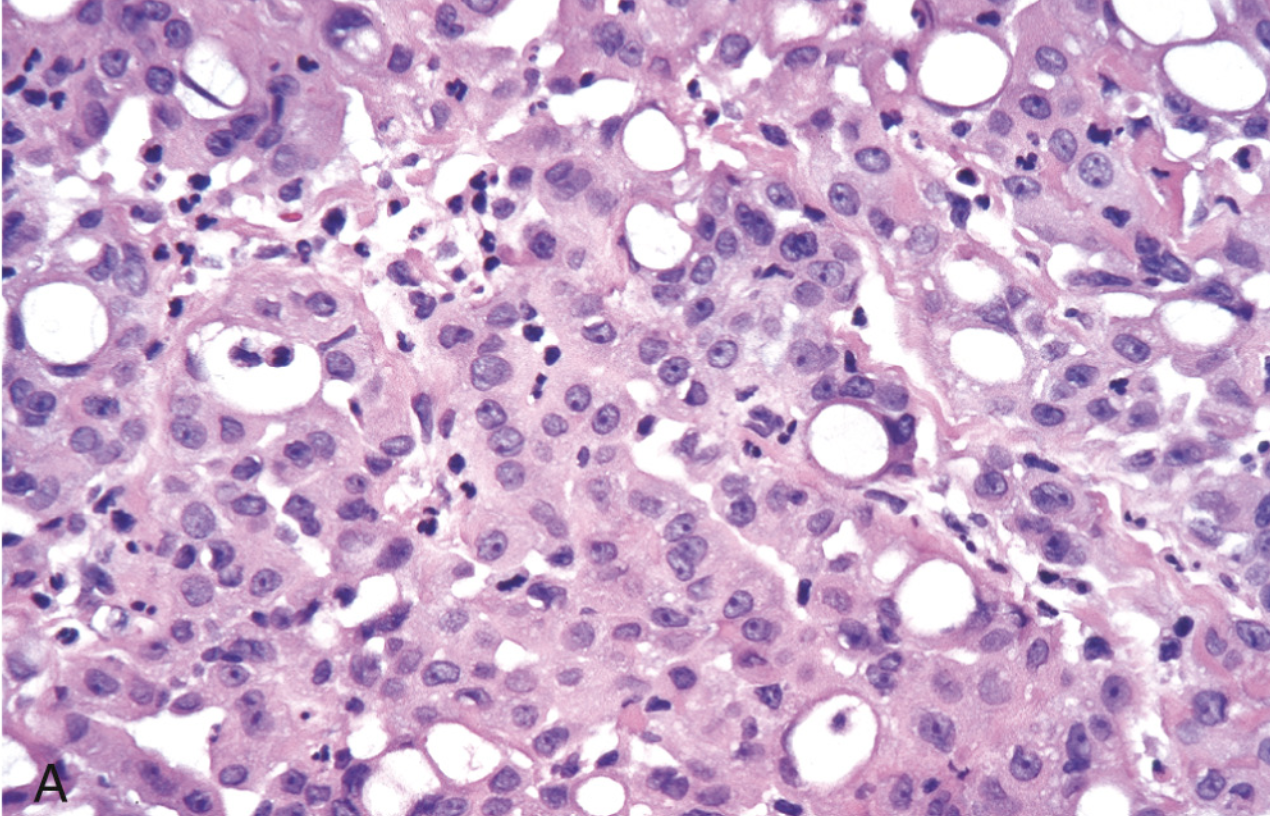 <p>Mesotelioma epiteloide</p>