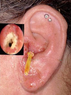 <p>Anatomy: skin-lined canal → similar to other skin infections</p><p>Main pathogens:</p><p>• Pseudomonas aeruginosa (most common)</p><p>• Staphylococcus aureus</p><p>• Candida spp., Aspergillus spp. (fungal otitis)</p><p>Clinical: pain, itching, redness, swelling, discharge</p><p>Treatment: cleaning + topical antibiotics (ciprofloxacin) ± antifungals</p>