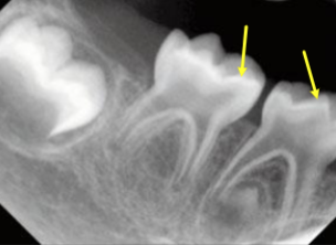 <p>large pulp horns and multiple none vital teeth without caries or trauma causing</p>