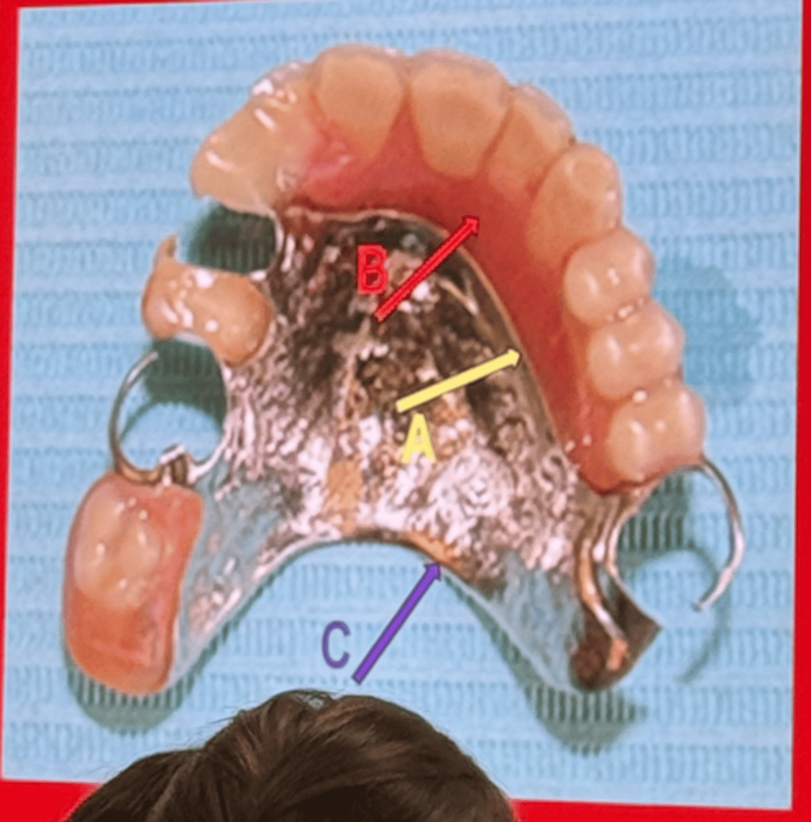 <p>- major connector</p><p>-MC full palatal coverage</p>