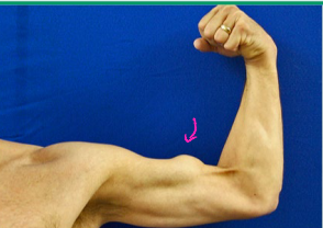<p><strong>Bicep Tendon Rupture</strong></p><p>-Mechanism of Injury</p><ul><li><p>Chronic irritation/_____________</p></li><li><p>Sudden load to ___________ bicep → catching heavy object, shoveling</p></li></ul><p>-S/S</p><ul><li><p>“___”, pain, ecchymosis, __________</p></li><li><p>Proximal tendon = _________ deformity, which is only present in the rupture of the long heads </p></li><li><p>Distal tendon = rarely any deformity, bicep ________ and hook tests </p></li></ul><p></p>
