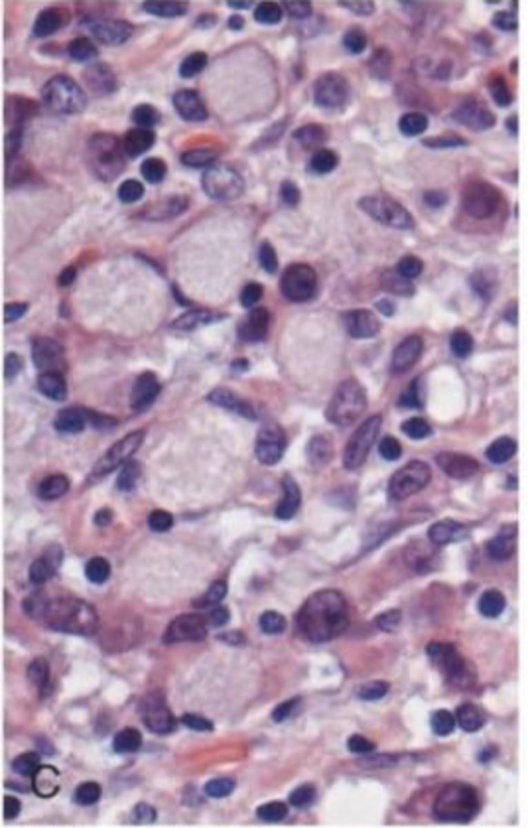 <p>the diffuse type</p>