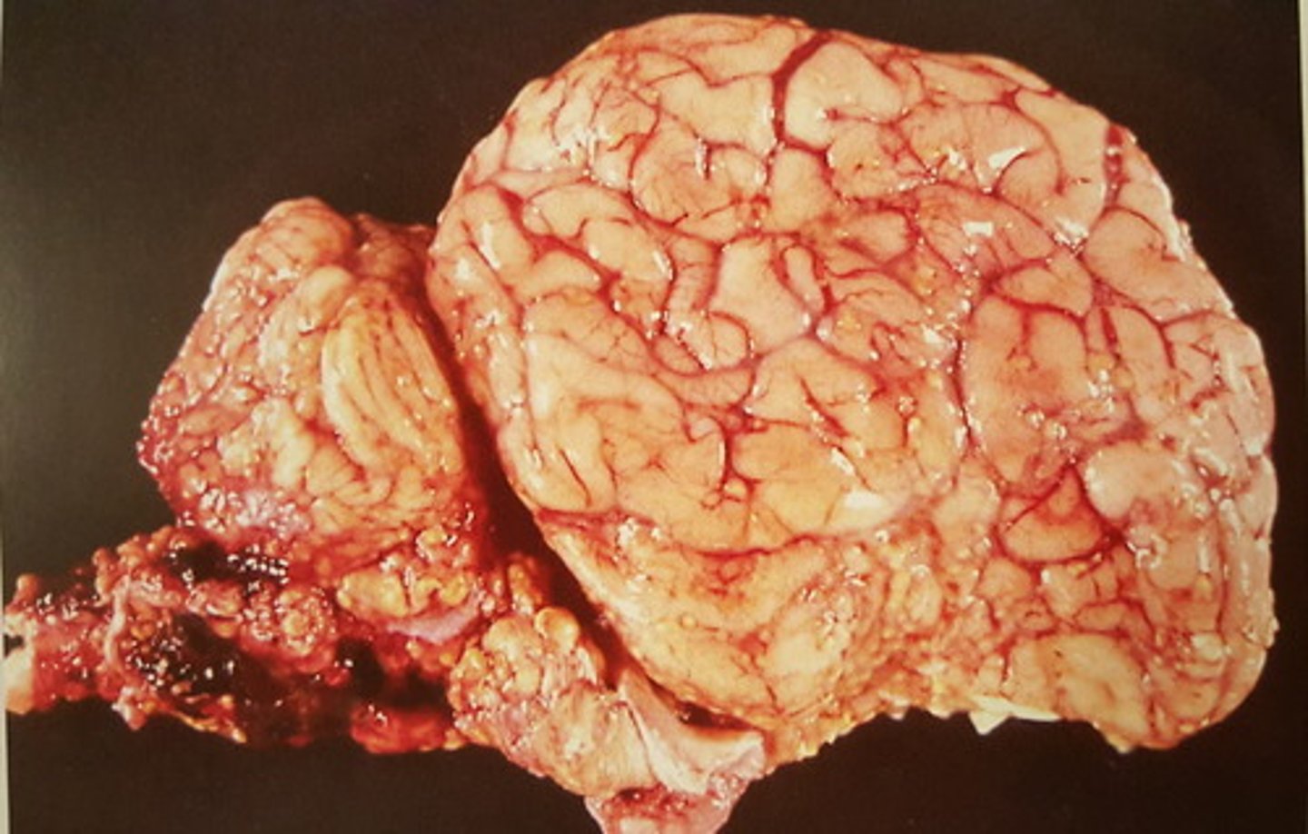 <p>Hjerne med hinde fra okse. Patoanatomisk diagnose? Ætiologi?</p>