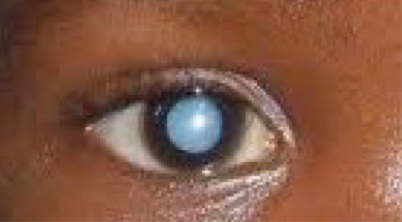 <ul><li><p>lenticular opacities present at birth</p></li><li><p><span><span>Highest prevalence in Asia</span></span></p></li><li><p><span><span>May have unilateral or bilateral presentation</span></span></p></li><li><p><span><strong><span>Symptoms</span></strong><span>: infants are unable to express symptoms, parents will present their concerns</span></span></p><ul><li><p><span><span>Leukocoria (white pupil)</span></span></p></li><li><p><span><span>Nystagmus</span></span></p></li><li><p><span><span>Strabismus</span></span></p></li></ul></li><li><p><u>4 causes</u>: genetic (50%, mostly AD), chromosomal abnormalities, metabolic disorders, intrauterine infections</p></li><li><p><u>4 categories</u>: zonular, polar, total/mature, membranous</p></li></ul><p></p>