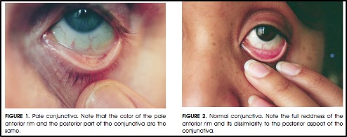 <p><span>pale conjunctiva, nail beds, and palmar creases</span></p><p><em>can reflect poor oxygenation, reduced perfusion, or anaemia</em></p>