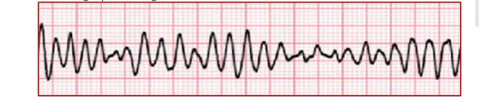 <p>Torsades de pointes</p>