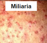 <p>what is miliara (heat rash)?</p>