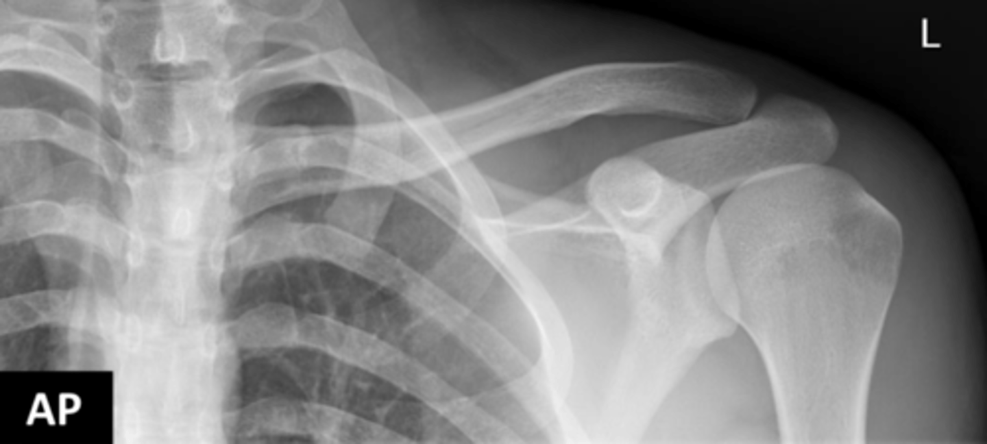<p>The standard radiological study for the clavicle is usually an AP (anteroposterior) image.</p>