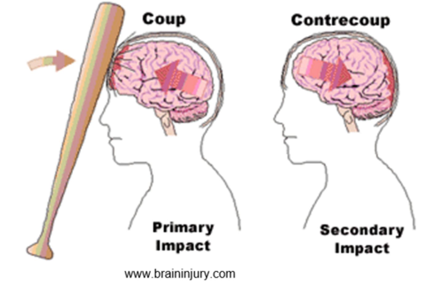 <p>Coup lesions are most severe when a stationary head is hit by a moving object,</p><p>Contrecoup lesions are most sever when a moving head bounces against a stationary object</p><p>(Start a coup with a baseball bat)</p>