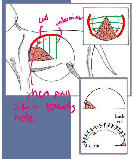 <ul><li><p>Y closure </p><ul><li><p>start at points of triangle and suture towards center </p></li><li><p>place horizontal type suture in center (where most tension is) </p></li></ul></li><li><p>rotational flaps </p><ul><li><p>semicircular / three quarter circular flap of skin rotated at a pivot point into the defect </p></li><li><p>single </p><ul><li><p>used when skin is available only on one side of the defect or rotation of skin results in a defect/distortion of adjacent structures </p></li></ul></li><li><p>bilateral </p><ul><li><p>little skin is available on both sides of defect </p></li></ul></li><li><p>4:1 length to width - prevent tension </p></li></ul></li></ul><p></p>
