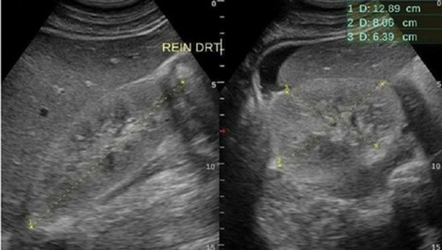 <p>Sonographically, a patient with AIDS will have ___ kidneys that may be ___ </p>
