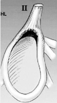 <p>Type II SLAP Lesion</p>