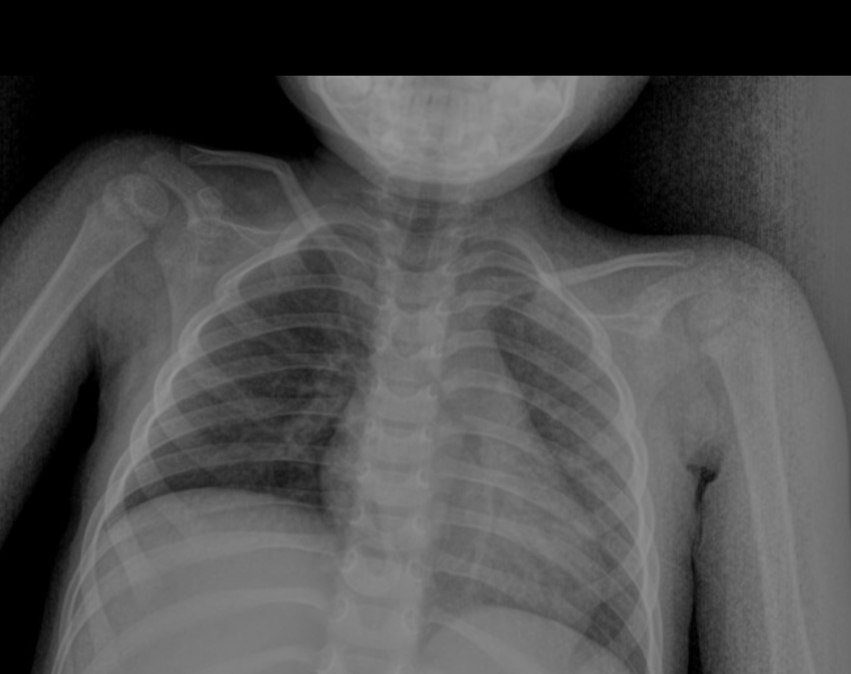 <p>Tell me about mid-shaft clavicle fractures</p>