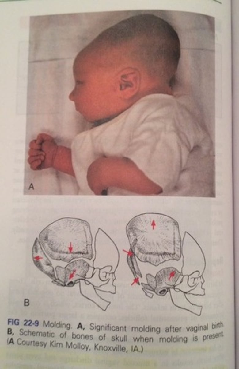 <p>Shaping of the fetal head during movement through the birth canal.</p>
