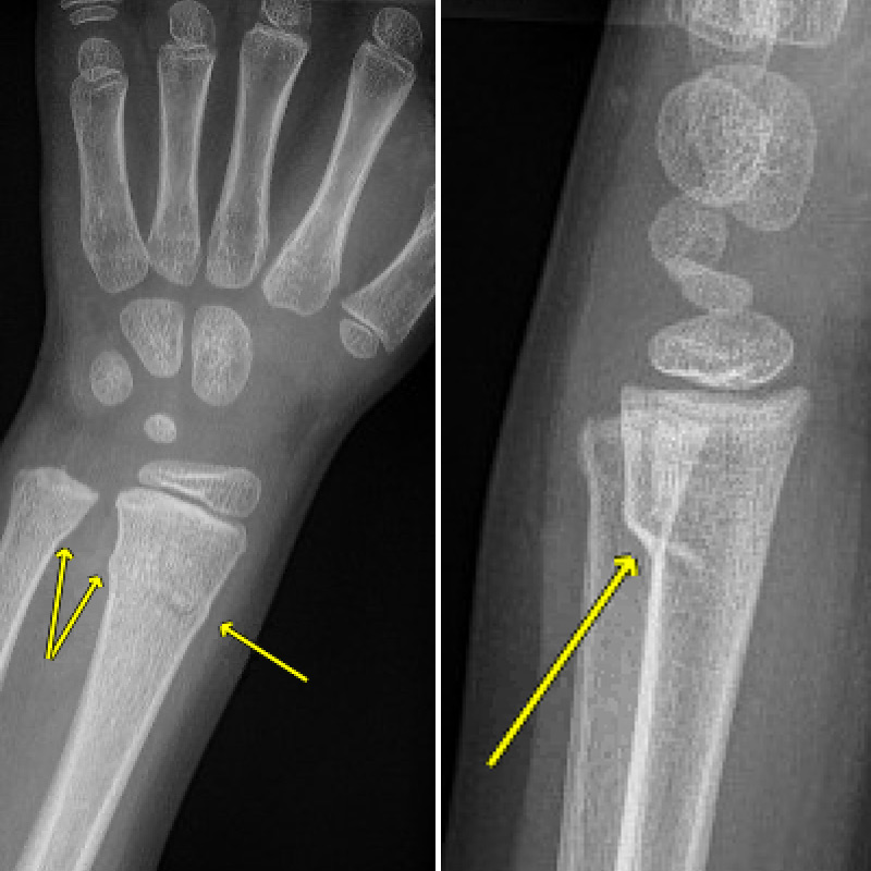 <p>TORUS/BUCKLE FRACTURE </p><p>referred to as a circumferential buckle fracture, commonly of the distal radial metaphysis. No distinct fracture line, but subtle deformity of buckle of the cortex may be evident. torus = protuberance in latin</p>