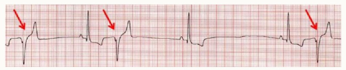 <ol><li><p>ventricles - no P wave</p></li><li><p>QRS are wide and bizarre</p></li><li><p>signal interrupts sinus (normal rhythm)</p></li><li><p>ectopic beat - premature impulse that starts in ventricles</p></li></ol><p><strong>these may look different in each ECG, the wave may e inverted in some and not in others - this is dependent on where the signal originates in the ventricles</strong></p><p></p>