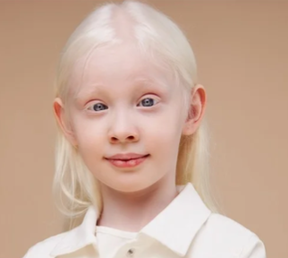 <p>Abnormal Skin Pigmentation Finding</p><ul><li><p>Total <strong>absence pigment</strong> on the skin</p></li><li><p><strong>No melanocytes</strong> (which are responsible for skin color - melanin)</p></li><li><p>Congenital (patient is born to have the condition) but <strong><u>not</u> hereditary</strong></p></li></ul><p></p>