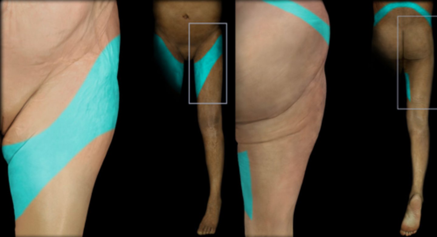 <p>Dermatome: Front of thigh and knee</p><p>Muscles innervated: Psoas, hip adductors</p><p>Reflexes (if any): None</p><p>Paresthesias: Anterior thigh</p>