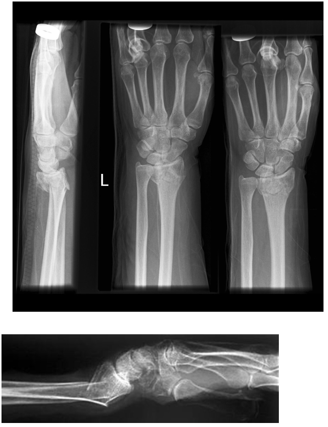 <p>Name this fracture</p>