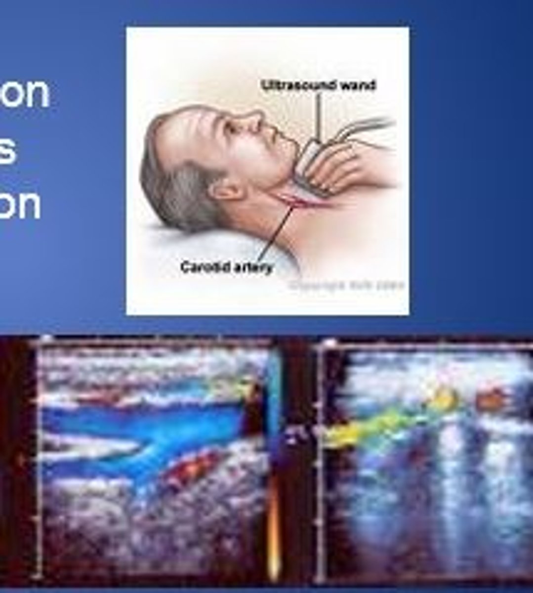 <p>ultrasound procedure that determines blood flow problems caused by blood clots, plaque, or tears on the walls of the carotid arteries</p>