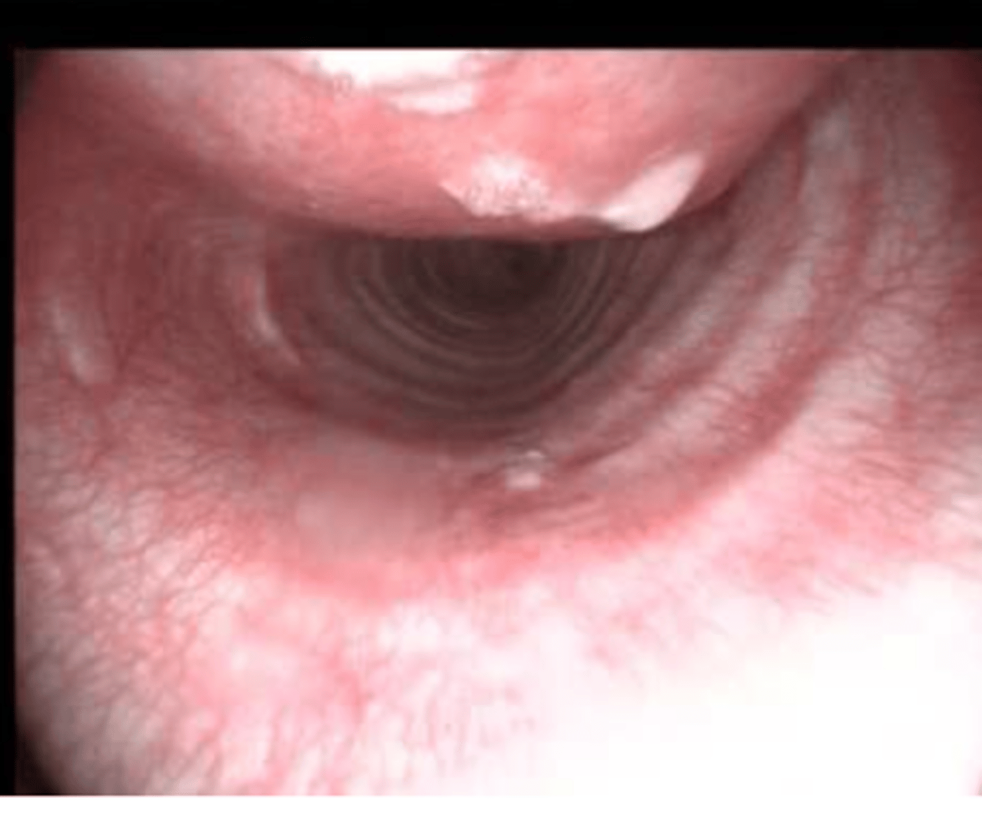 <p>trachea- what is the problem?</p>