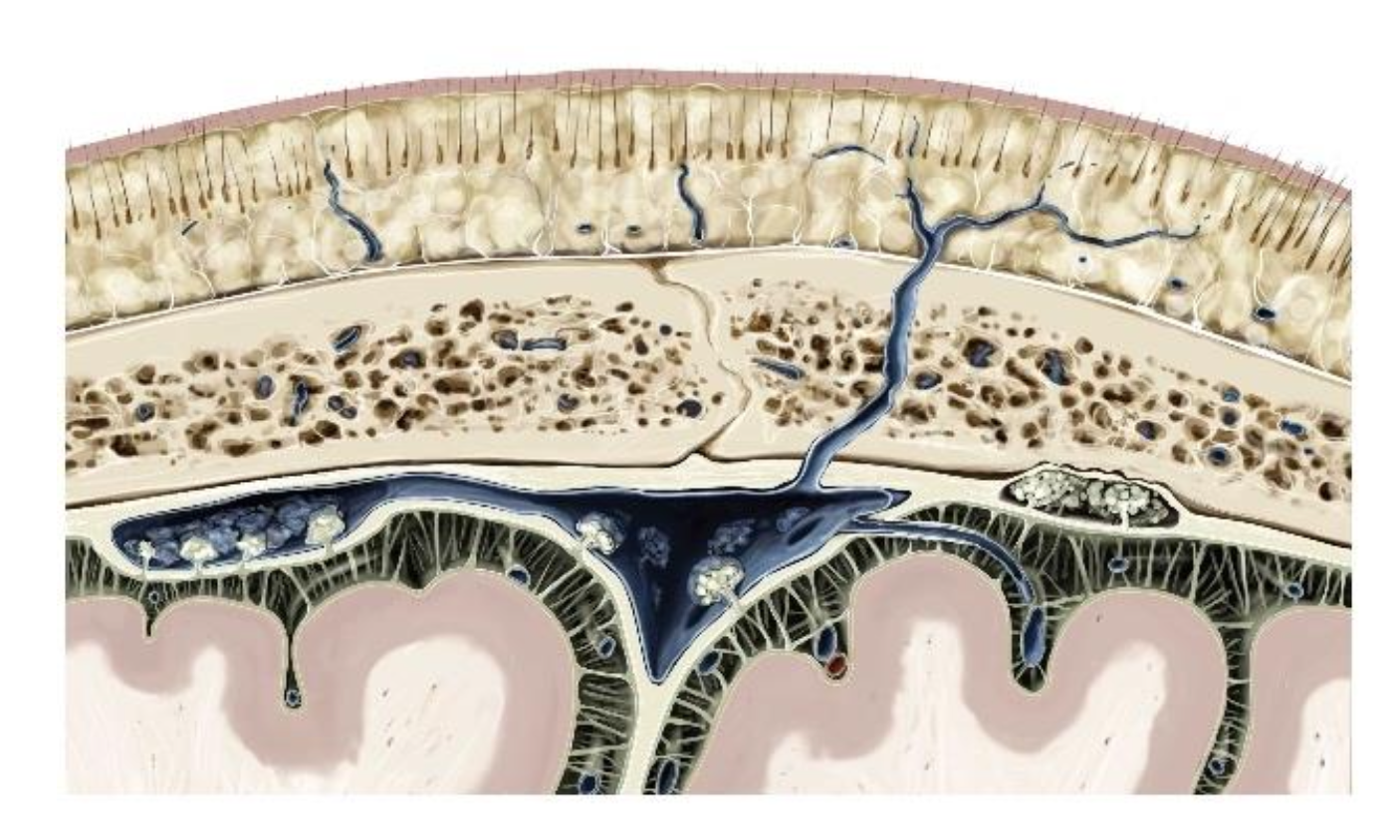 <ul><li><p class="my-2 [&amp;+p]:mt-4 [&amp;_strong:has(+br)]:inline-block [&amp;_strong:has(+br)]:pb-2">Reabsorbed into venous blood via extensions (villi) of the arachnoidea, which extends into large veins </p></li><li><p class="my-2 [&amp;+p]:mt-4 [&amp;_strong:has(+br)]:inline-block [&amp;_strong:has(+br)]:pb-2">Pressure gradient favors one-way flow </p></li></ul><p></p>