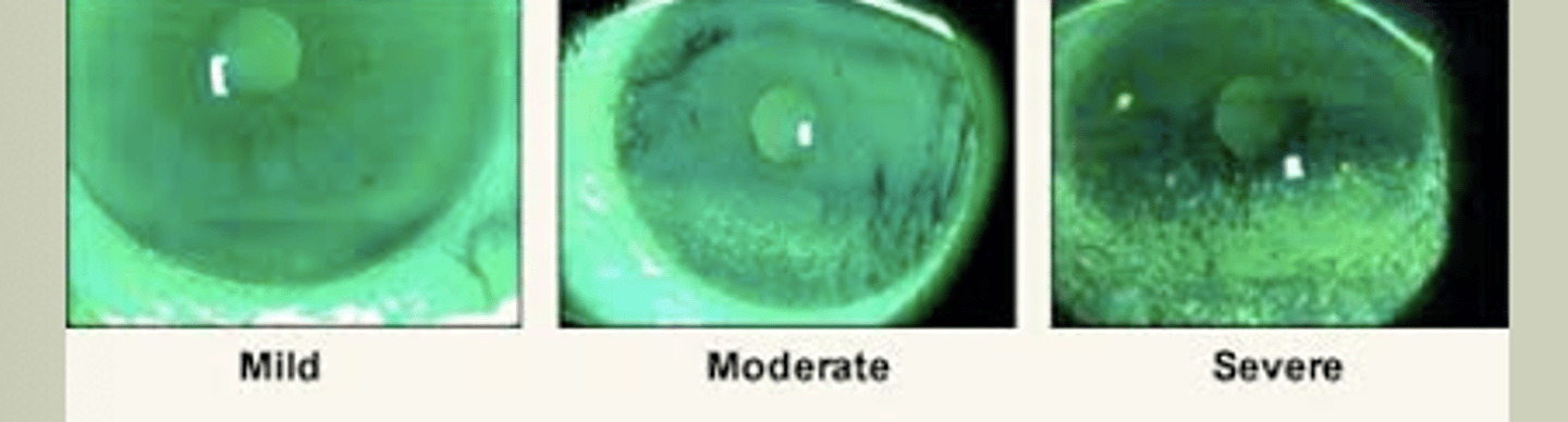 <p>-Multifactorial disease of tears and ocular surface</p><p>-Eye discomfort, visual disturbance &amp; tear film instability</p><p>-Etiologies: Evaporative (MC) tear evaporate too quikcly; &amp; Aqueous Deficient is lack of production from lacrimal gland</p><p>-Dryness, mild pain, foreign body sensation, redness</p><p>-Signs: Injection/hyperemia, lid disease, debris in tear film</p><p>-TX: refer to eyecare for chronic management</p>