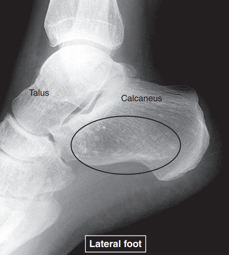 <p>overall increase in skeletal density</p>