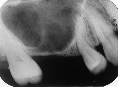 <p><span><span>Note the dilacerated premolar root. The condition that affects this sinus is</span></span></p><p>&nbsp;</p><p>acute sinusitis</p><p>&nbsp;</p><p>chronic sinusitis</p><p>&nbsp;</p><p>sinus elongation</p><p>&nbsp;</p><p>pneumatization</p>