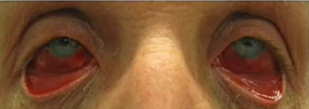 <ol><li><p><u>significant conj hyperemia and hemorrhages </u></p></li><li><p>sig chemosis </p></li><li><p>lid edema</p></li><li><p>FB sensation</p></li></ol><p></p>
