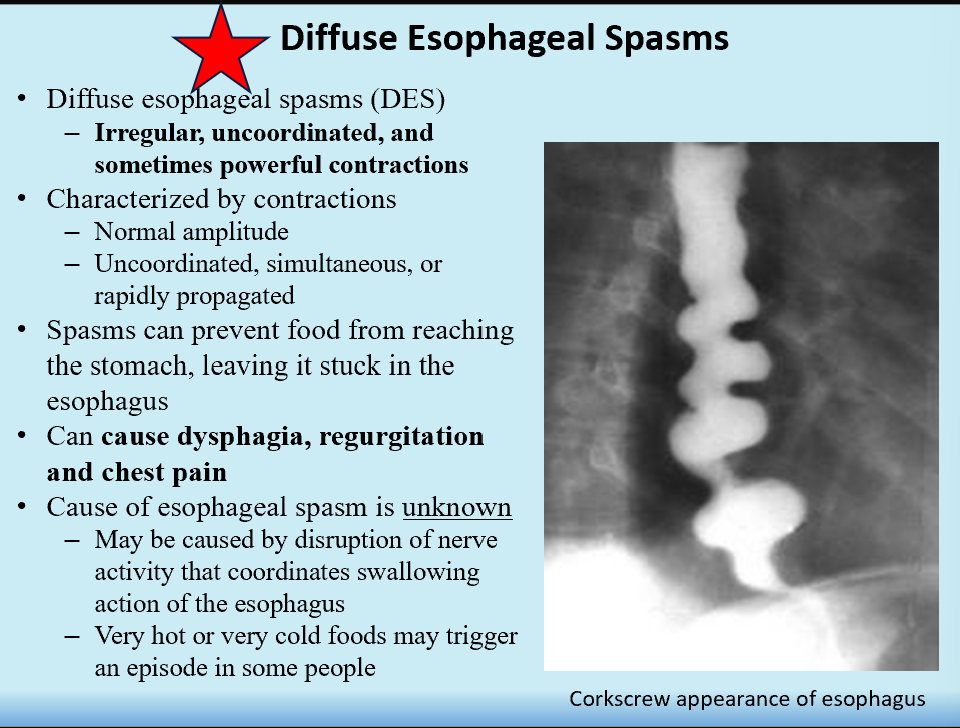 <p>Irregular, uncoordinated esophageal contractions</p><p>Contractions can be powerful</p><p>Sx:</p><ul><li><p>dysphagia</p></li><li><p>regurgitation</p></li><li><p>chest pain</p></li></ul><p><strong>Corkscrew esophagus appearance!</strong></p><p></p>