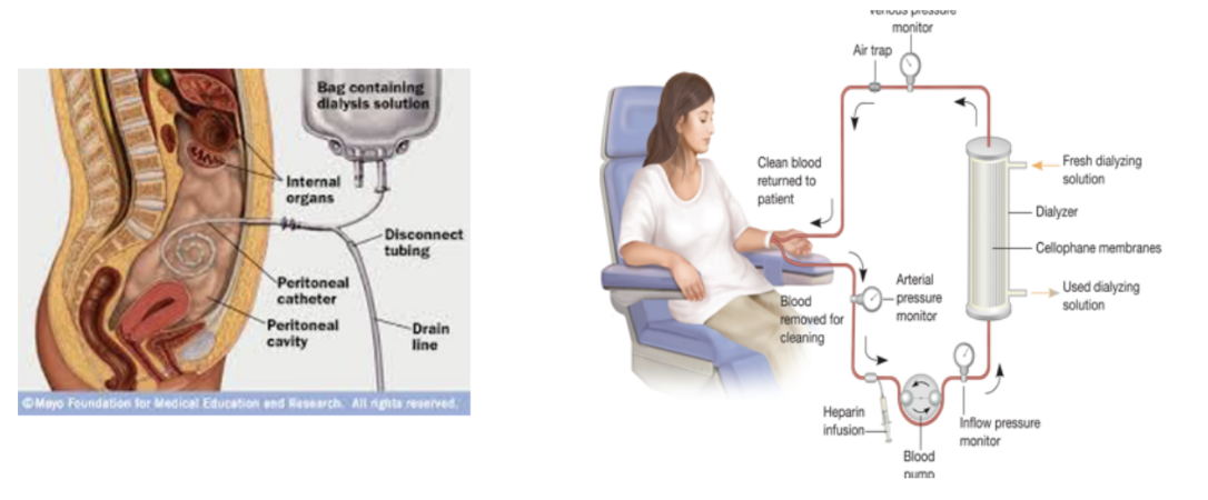 <p>Needed for survival for people with renal failure (kidneys won’t filter blood) — 2 methods —</p><ul><li><p>Hemodialysis —</p><ul><li><p>Blood is taken from the circulation, dialyzed through a complex artificial membrane, &amp; returned to the body</p></li><li><p>A high blood flow rate is needed to remove excess body fluid, exchange electrolytes, &amp; remove noxious metabolites, which is accomplished by either —</p><ul><li><p>Arteriovenous fistula is established surgically (connecting artery to vein, usually in upper limb (needs 6 weeks to ‘mature’, cannulated each time patient returns for dialysis) </p></li></ul></li></ul></li><li><p>Peritoneal dialysis —</p><ul><li><p>Peritoneum is used as dialysis membrane — large surface area of peritoneal cavity is an ideal dialysis </p></li></ul></li></ul>