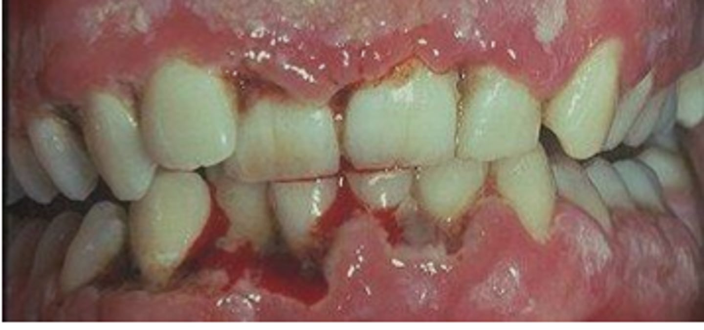 <p>Punched out papilla</p><p>Profuse bleeding</p><p>Fever</p><p>Fatigue</p><p>Swollen lymph nodes</p><p>Rapid onset</p>