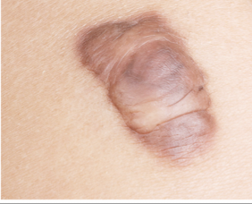 <p><strong>erythematous, bulging and firm, focally raised scar</strong><br>-can develop <strong>months-years after trauma w/o spontaneous regression</strong><br>-genetic predisposition; increased incidence in African/Asian descent<br>-<strong>located primarily on chest and shoulders, also ear lobes</strong></p>